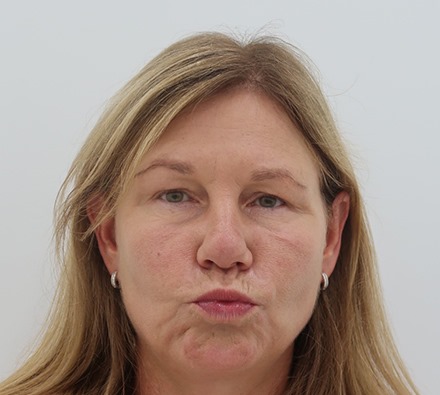 Plasma IQ: smokers' lines, upper and lower eyes.