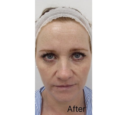 Skin transformation by Dr Leah Clinic