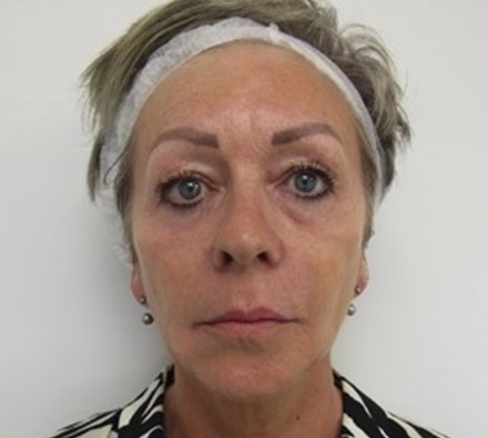 Before and After Silhouette Soft Thread Lift 
