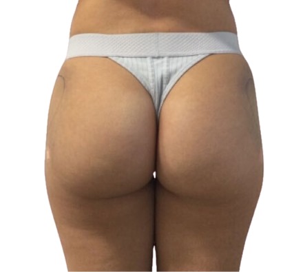 Before and after Lanluma non-surgical bum lift
