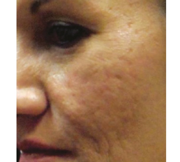 Before and After PRP Facial (vampire facial)
