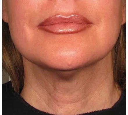 Ultherapy before and after