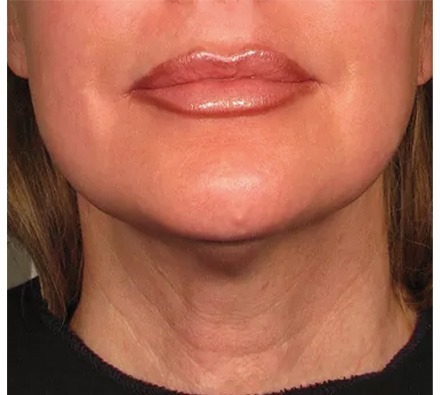 Ultherapy Neck Before and After, *Individual results may vary