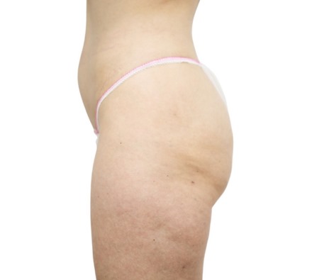 Lanluma Bum Lift Before and After 