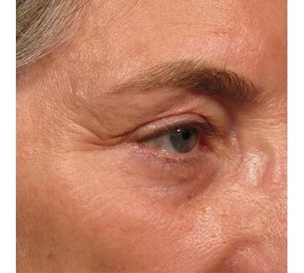 Ultherapy Eye Area Before and After, *Individual results may vary