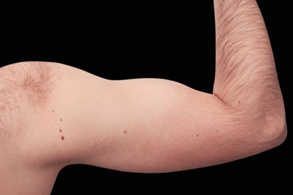 Male arm before and after Emsculpt Neo. Photos courtesy of Raminder Saluja, M.D.