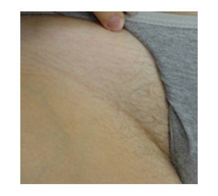 Soprano ICE bikini line hair removal