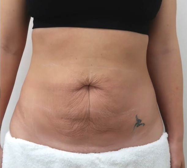 Before and after Dr Leah's Mummy Tummy Makeover treatment