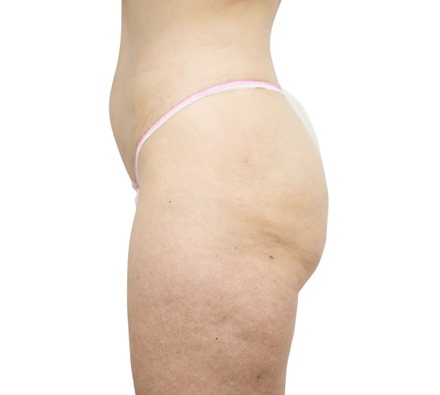 Lanluma Bum Lift Before and After
