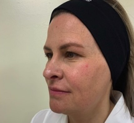 Before and after thread lift