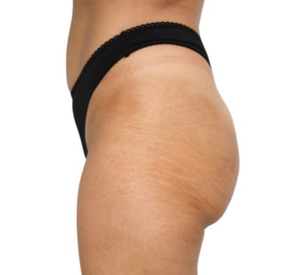 Lanluma Bum Lift Before and After 