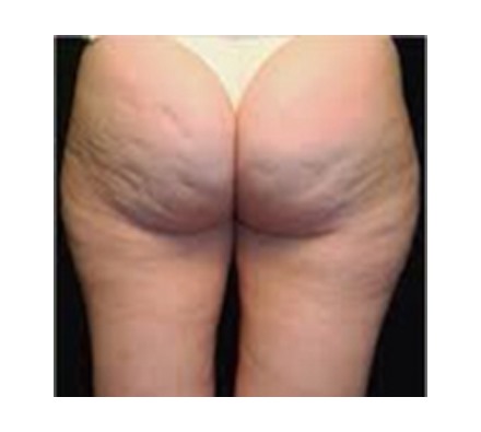 Cellulite treatment