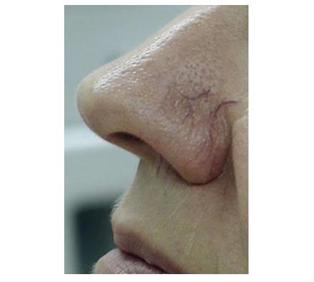 Thread veins on nose treated with vascular laser