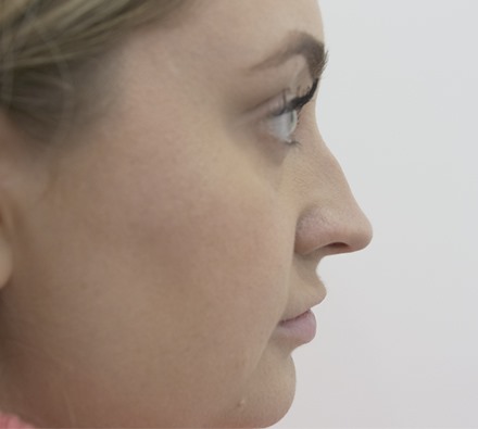 Before and After Non-surgical Rhinoplasty 