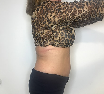 Before and after fat freezing at Dr Leah Clinic (photos 12 weeks apart)