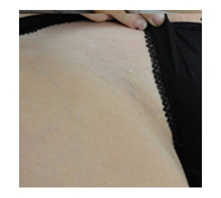 Soprano ICE bikini line hair removal