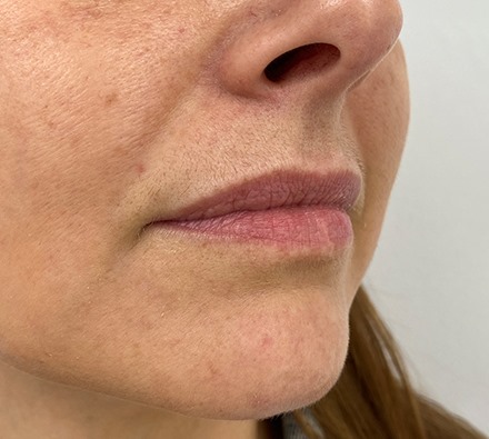 MaiLi Lip Dermal Filler (1ml) Before and Immediately After