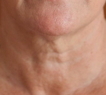 Profhilo neck before and after