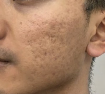 Dermapen and Uber Pro Peel for Acne Scarring Before and After