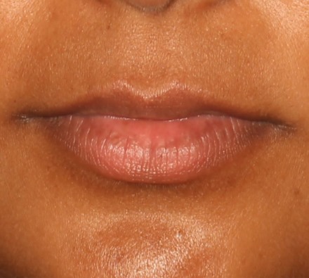 Lip filler before and after (1ml)
