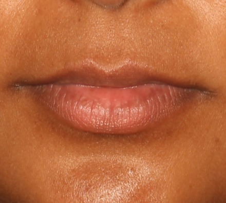 Lip Filler Before and After 1ml