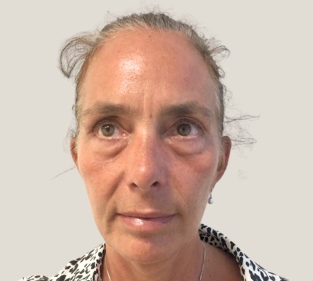 Before and after Morpheus8 treatment. Individual results may vary.