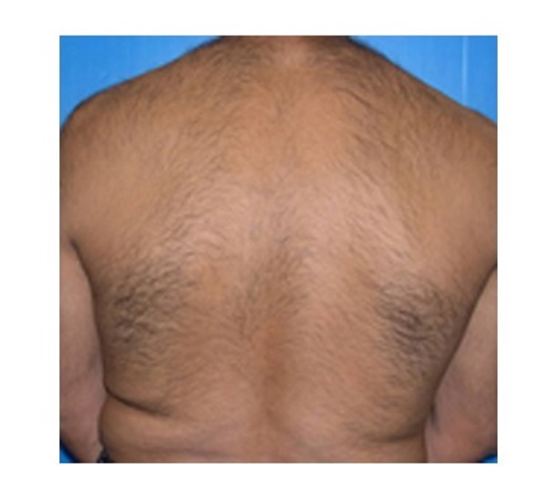 Back hair before and after Soprano ICE laser treatment