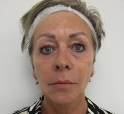 Before and after thread lift