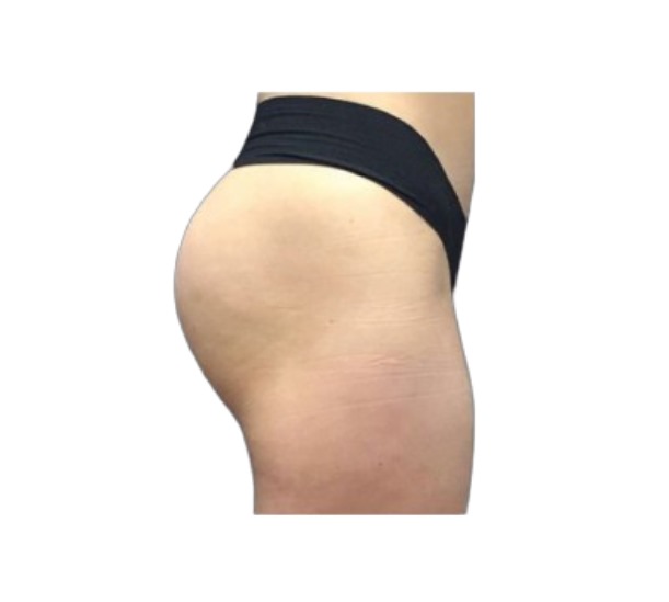 Dr Leah Clinics EmSculpt Neo non-surgical bum lift before and after