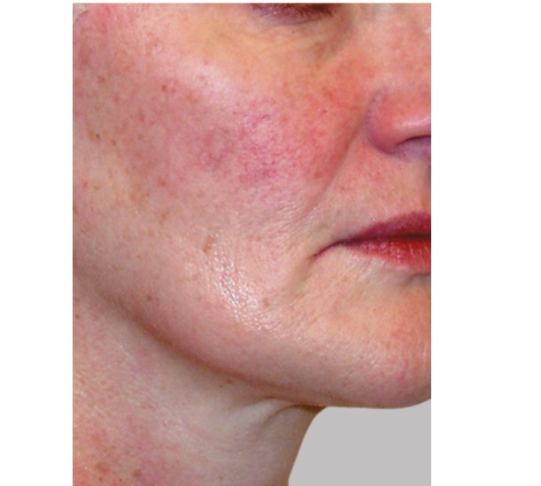 Before and After PRP Facial Therapy