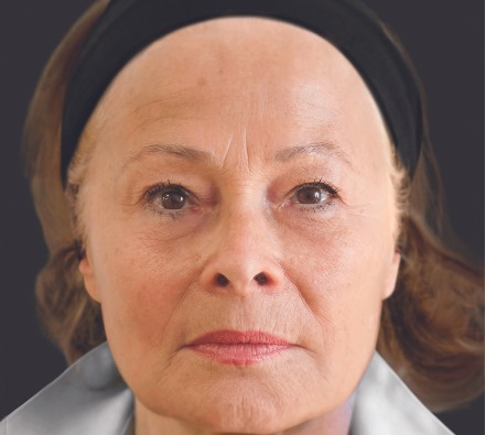 Here are some examples of the results we're able to achieve with Ellansé dermal filler...