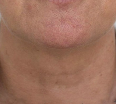 Profhilo neck before and after