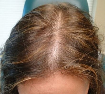 PRP Hair Loss Treatment Before and After 