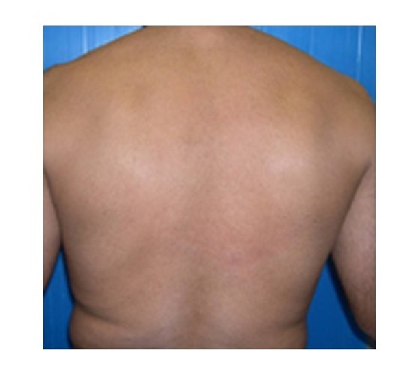 Back hair before and after Soprano ICE laser treatment