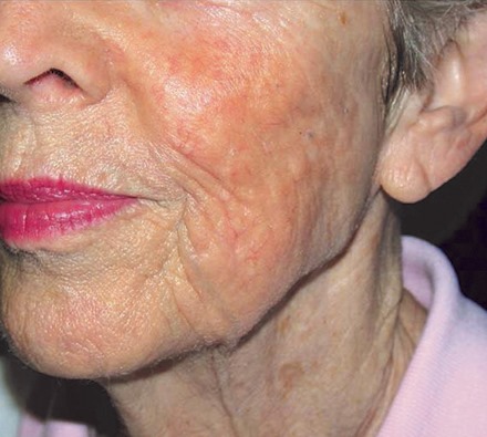Thread veins on face treated with Dr Leah Clinic vascular laser 