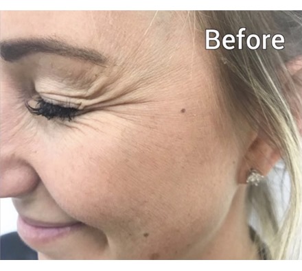 Crow's feet - Dr Leah Clinic