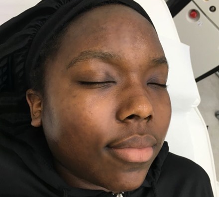 Before and after Obagi Blue Peel x3. Paired with at-home Obagi skin care.