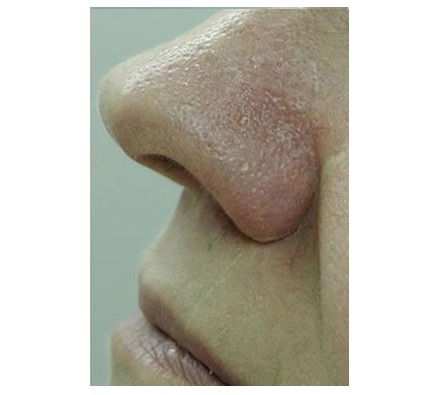 Thread veins on nose treated with vascular laser