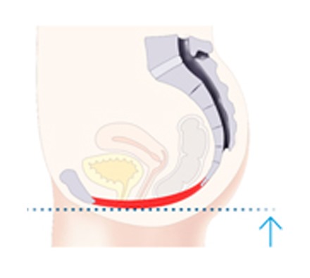 Pelvic floor Before and After Emsella treatment 