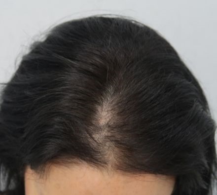 PRP Hair Loss Treatment Before and After