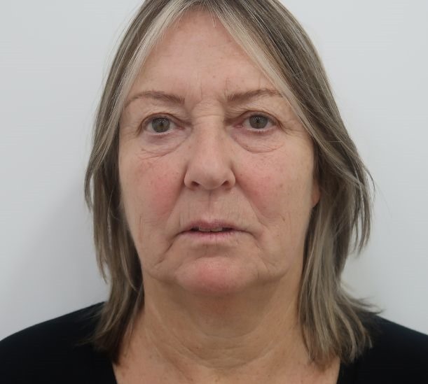 Quantum RF before and 10 weeks after treatment