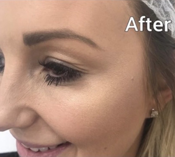 Crow's feet before and after anti-wrinkle injections