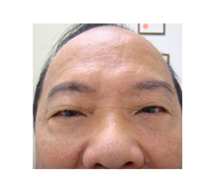 Lines on forehead and improvement to eye bags