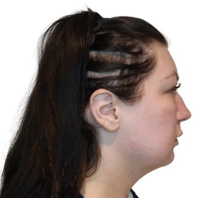Before and after fat dissolving treatment