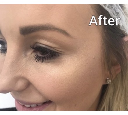 Crow's feet - Dr Leah Clinic