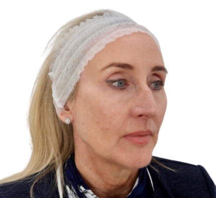 Before and after thread lift
