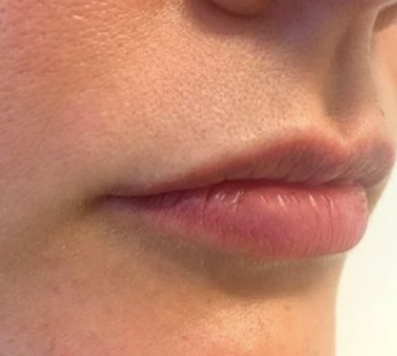 Lip filler (1ml MaiLi) before and after