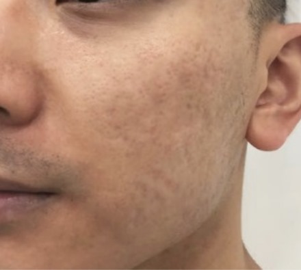 Dermapen and Uber Pro peel for acne scarring - before and after