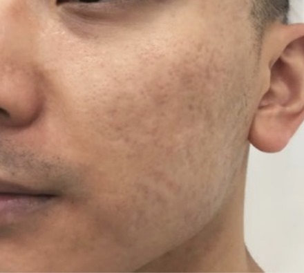 Dermapen and Uber Pro Peel for Acne Scarring Before and After