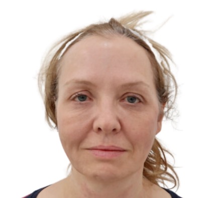 Before and after thread lift